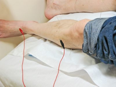 Electro acupuncture